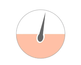 VIOの毛を抜くと危険？埋没毛の原因と正しい対処法